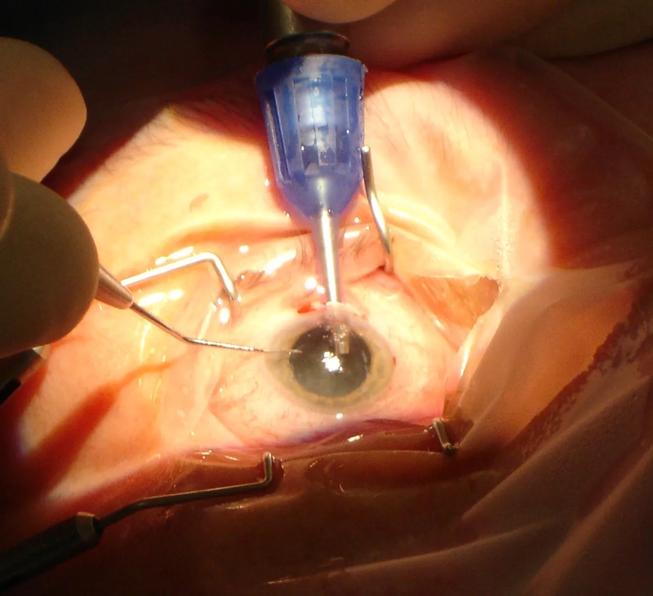 behandeling-cataract-koksijde-7