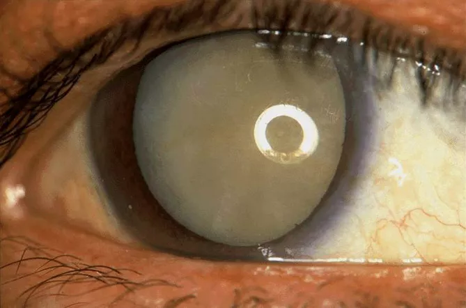 behandeling-cataract-koksijde-1